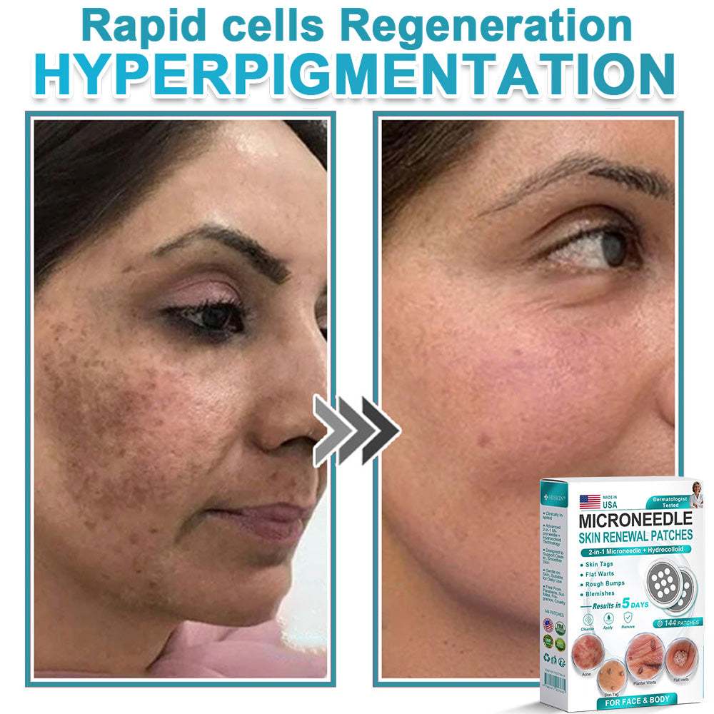 Hiskin ® 2-in-1 Microneedle & Hydrocolloid Patch👨‍⚕️ | Removes raised moles, acne, flat warts, and skin tags | Helps improve wrinkles, scars, and blemishes | Invisible patches for face and body