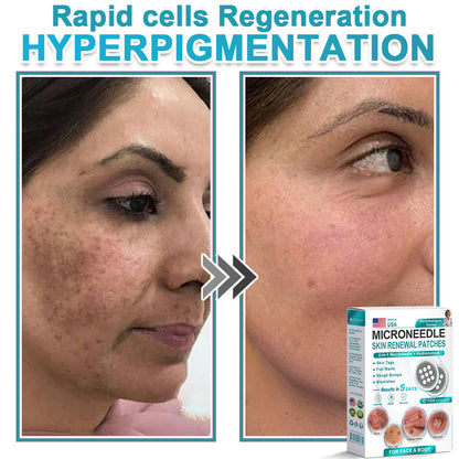 Hiskin ® 2-in-1 Microneedle & Hydrocolloid Patch👨‍⚕️ | Removes raised moles, acne, flat warts, and skin tags | Helps improve wrinkles, scars, and blemishes | Invisible patches for face and body
