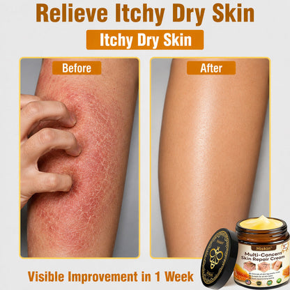 HISKIN® Multi-Concern Skin Repair Cream (One powerful cream to repair inflammation, dryness, aging, pigmentation, and visible skin damage.)