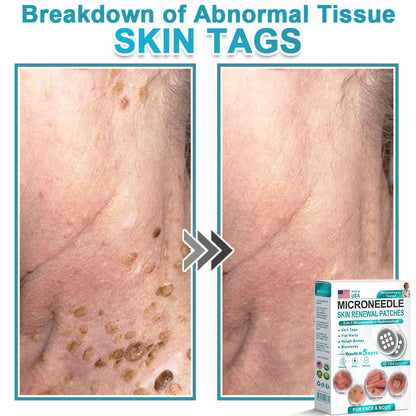 Hiskin ® 2-in-1 Microneedle & Hydrocolloid Patch👨‍⚕️ | Removes raised moles, acne, flat warts, and skin tags | Helps improve wrinkles, scars, and blemishes | Invisible patches for face and body