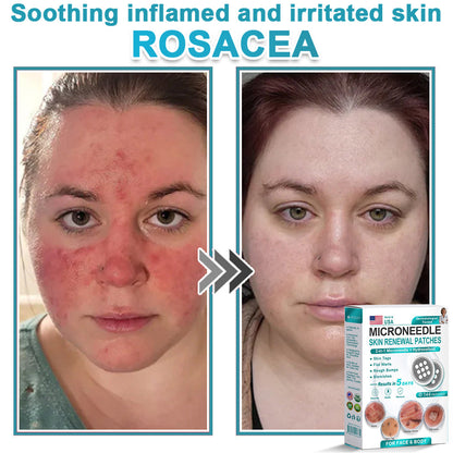 Hiskin ® 2-in-1 Microneedle & Hydrocolloid Patch👨‍⚕️ | Removes raised moles, acne, flat warts, and skin tags | Helps improve wrinkles, scars, and blemishes | Invisible patches for face and body