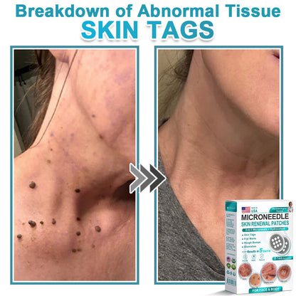 Hiskin ® 2-in-1 Microneedle & Hydrocolloid Patch👨‍⚕️ | Removes raised moles, acne, flat warts, and skin tags | Helps improve wrinkles, scars, and blemishes | Invisible patches for face and body