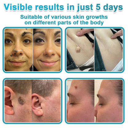 Hiskin ® 2-in-1 Microneedle & Hydrocolloid Patch👨‍⚕️ | Removes raised moles, acne, flat warts, and skin tags | Helps improve wrinkles, scars, and blemishes | Invisible patches for face and body