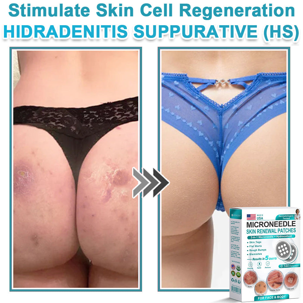 Hiskin ® 2-in-1 Microneedle & Hydrocolloid Patch👨‍⚕️ | Removes raised moles, acne, flat warts, and skin tags | Helps improve wrinkles, scars, and blemishes | Invisible patches for face and body