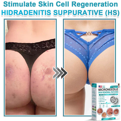 Hiskin ® 2-in-1 Microneedle & Hydrocolloid Patch👨‍⚕️ | Removes raised moles, acne, flat warts, and skin tags | Helps improve wrinkles, scars, and blemishes | Invisible patches for face and body