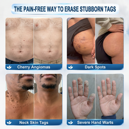 𝐇𝐈𝐒𝐊𝐈𝐍®👩‍⚕️ 𝟕-𝐃𝒂𝘆 𝐒𝗸𝐢𝐧 𝐓𝒂𝗴 & 𝐒𝐩𝙤𝐭 𝐄𝐫𝒂𝐬𝙚𝐫 Painless & Scar-Free Advanced Imperfection Removal Rollerball Pen