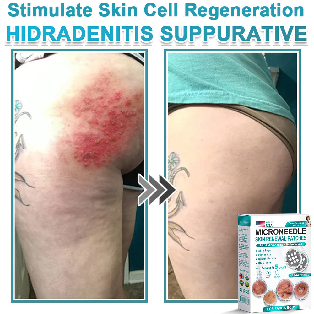Hiskin ® 2-in-1 Microneedle & Hydrocolloid Patch👨‍⚕️ | Removes raised moles, acne, flat warts, and skin tags | Helps improve wrinkles, scars, and blemishes | Invisible patches for face and body