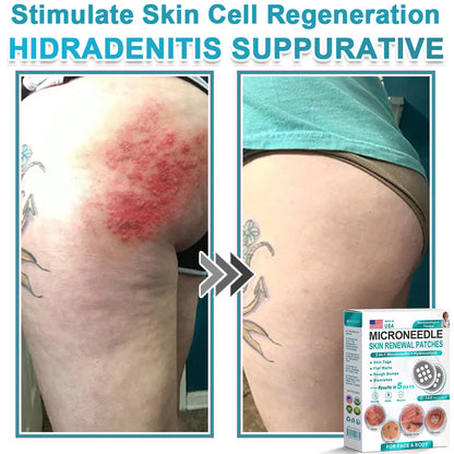 Hiskin ® 2-in-1 Microneedle & Hydrocolloid Patch👨‍⚕️ | Removes raised moles, acne, flat warts, and skin tags | Helps improve wrinkles, scars, and blemishes | Invisible patches for face and body