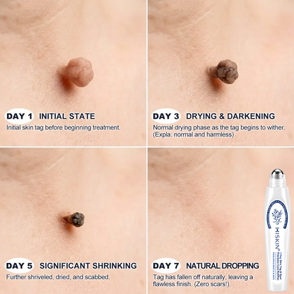 𝐇𝐈𝐒𝐊𝐈𝐍®👩‍⚕️ 𝟕-𝐃𝒂𝘆 𝐒𝗸𝐢𝐧 𝐓𝒂𝗴 & 𝐒𝐩𝙤𝐭 𝐄𝐫𝒂𝐬𝙚𝐫 Painless & Scar-Free Advanced Imperfection Removal Rollerball Pen
