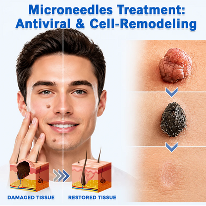 Hiskin ® 2-in-1 Microneedle & Hydrocolloid Patch👨‍⚕️ | Removes raised moles, acne, flat warts, and skin tags | Helps improve wrinkles, scars, and blemishes | Invisible patches for face and body