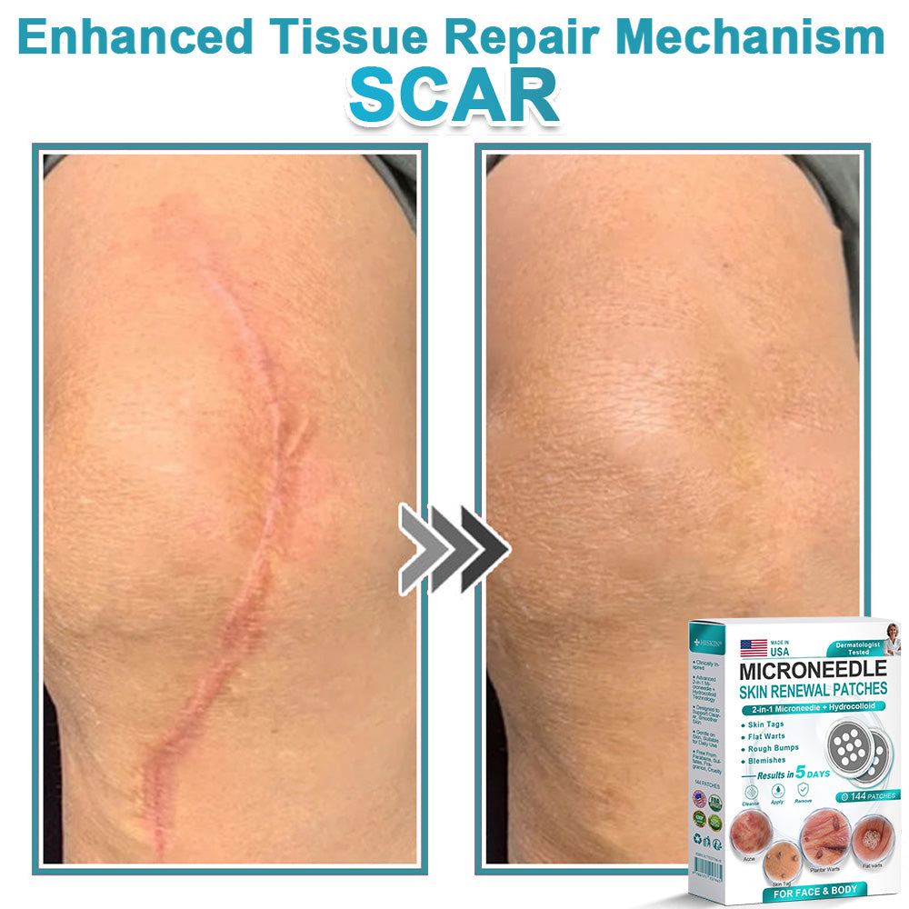 Hiskin ® 2-in-1 Microneedle & Hydrocolloid Patch👨‍⚕️ | Removes raised moles, acne, flat warts, and skin tags | Helps improve wrinkles, scars, and blemishes | Invisible patches for face and body