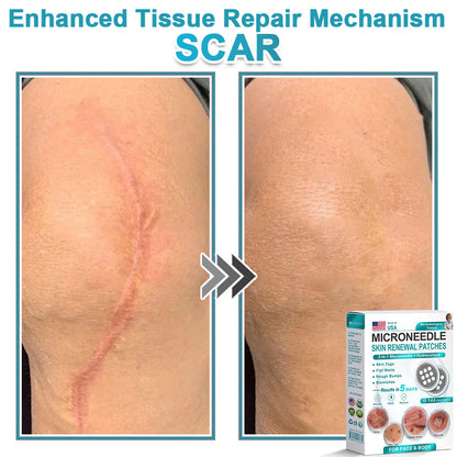 Hiskin ® 2-in-1 Microneedle & Hydrocolloid Patch👨‍⚕️ | Removes raised moles, acne, flat warts, and skin tags | Helps improve wrinkles, scars, and blemishes | Invisible patches for face and body