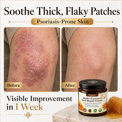 HISKIN® Multi-Concern Skin Repair Cream (One powerful cream to repair inflammation, dryness, aging, pigmentation, and visible skin damage.)